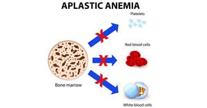 Лечение апластической анемии стволовыми клетками – уже второй успешный случай
